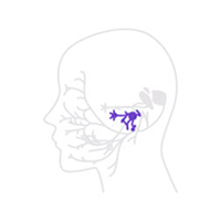 구안와사 청각 과민