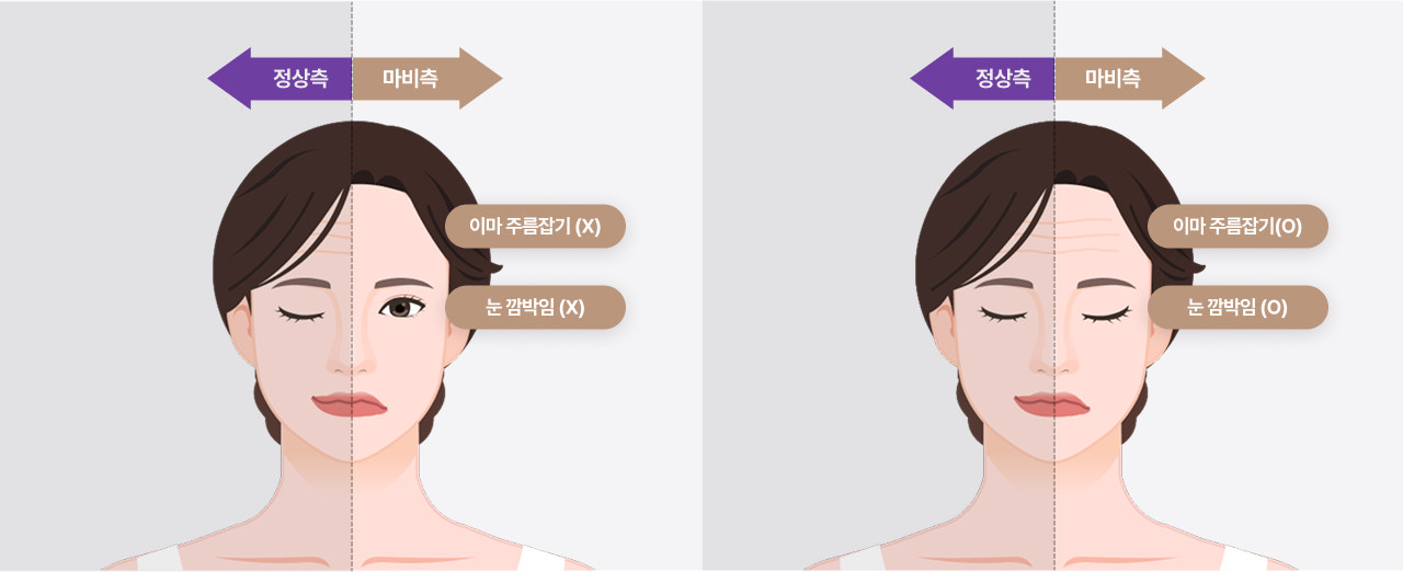 말초성 안면마비 이마주름잡기X, 눈감기X vs 중추성 안면마비 이마주름잡기O, 눈감기O