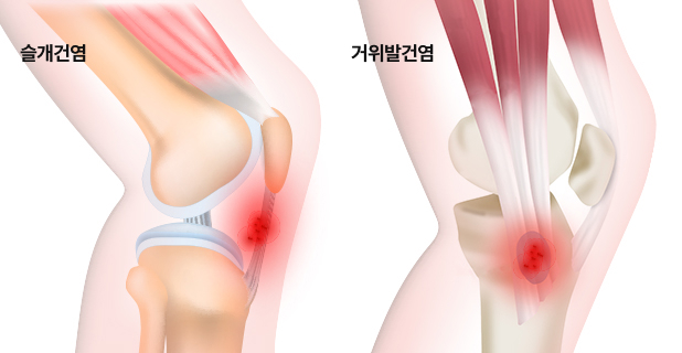 슬개건염, 거위발건염