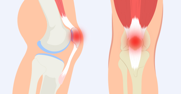 슬개골 연골연화증