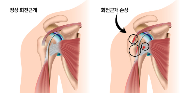 어깨충돌증후군 