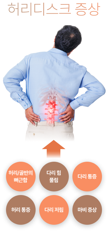 허리 디스크 증상 다리 통증, 다리 힘 풀림, 허리/골반의 뻐근함, 마비 증상, 다리 저림, 허리 통증